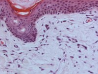 Scleromyxoedeem (lichen myxoedematosus)