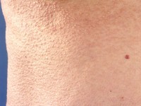 Scleromyxoedeem (lichen myxoedematosus)