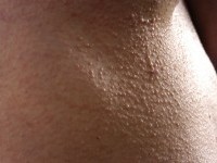 Scleromyxoedeem (lichen myxoedematosus)