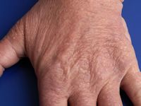 Lichen myxoedematosus