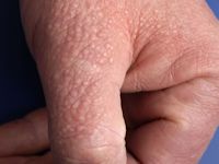 Lichen myxoedematosus