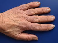 Lichen myxoedematosus