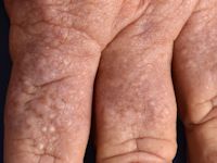 Lichen myxoedematosus