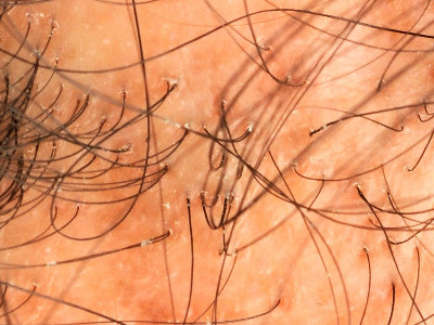 Klassieke lichen planopilaris