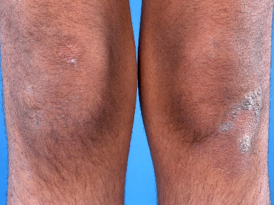 Klassieke lichen planopilaris