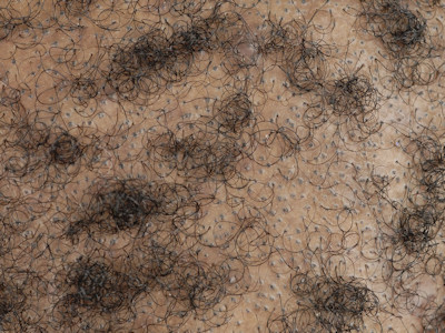 Klassieke lichen planopilaris