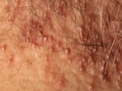 Lichen planopilaris