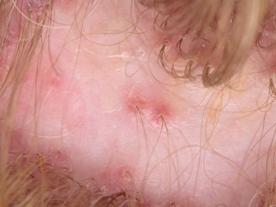 Klassieke lichen planopilaris