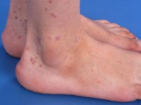Lichen planus