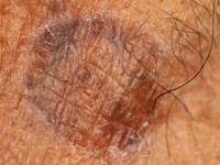 Lichen planus actinicus