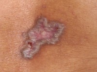 Annulaire lichen planus