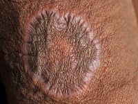 Annulaire lichen planus