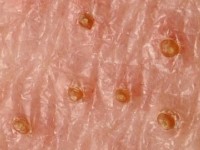 Folliculaire lichen planus (lichen planopilaris) op het lichaam