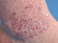 Folliculaire lichen planus (lichen planopilaris) op het lichaam