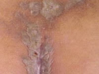 Lichen planus hypertrofica