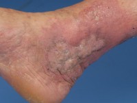 Lichen planus hypertrofica