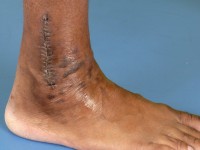 Lichen planus nagels