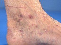 Lichen planus nagels