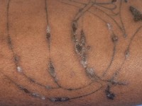 Lichen planus nagels