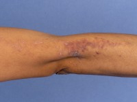 Lineaire lichen planus