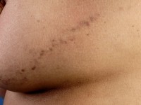 Lineaire lichen planus