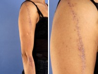 Lineaire lichen planus