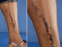 Lineaire lichen planus