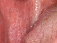 Lichen planus mucosae