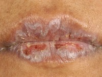 Lichen planus mucosae