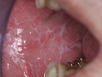 Lichen planus mucosae