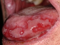 Lichen planus mucosae