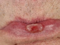 Lichen planus mucosae