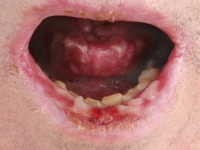 Lichen planus mucosae