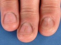 Lichen planus nagels
