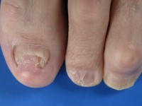 Lichen planus nagels