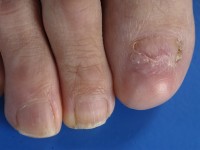 Lichen planus nagels