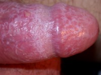 Lichen planus mucosae