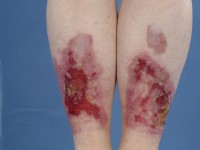 Lichen planus ulcera