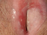 Lichen planus mucosae