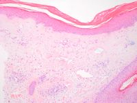 Histologie van lichen sclerosus