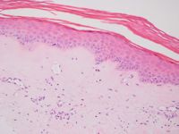 Histologie van lichen sclerosus