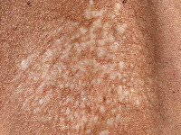 Lichen sclerosus - morfea mengbeeld