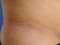 Lichen sclerosus op de romp