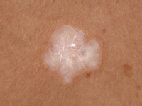 Lichen sclerosus on the trunk