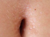 Lichen sclerosus guttata type