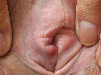 Lichen sclerosus on the vulva