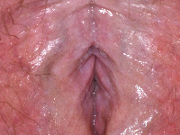 Lichen sclerosus op de vulva