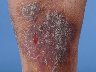 Lichen simplex chronicus