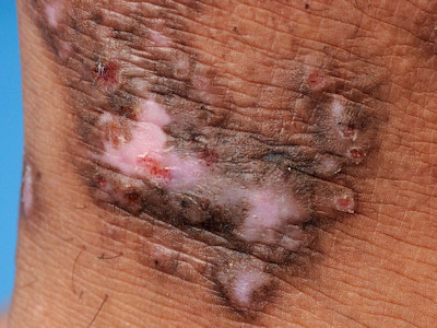 Lichen simplex chronicus