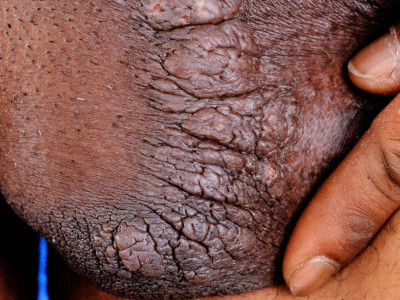 Lichen simplex chronicus